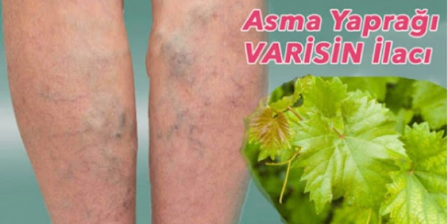 Varisi Tamamen Yok Ediyor