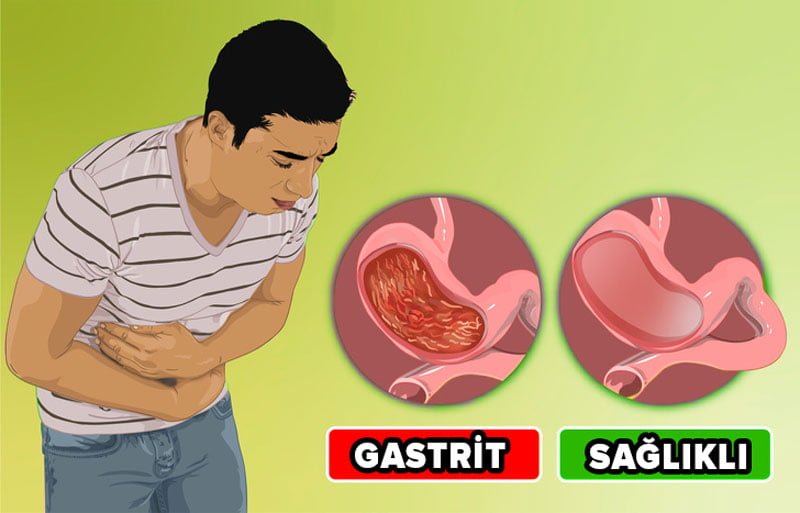 Gastrit Olup Olmadığınızı Bu Şekilde Anlayabilirsiniz
