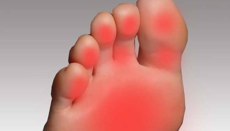 Ayaklarda Yanmanın Sebebi