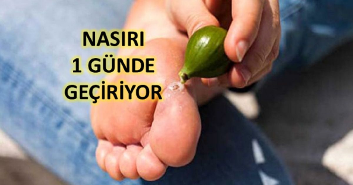 Nasırı 1 Günde Geçiren Tedavi Yöntemi