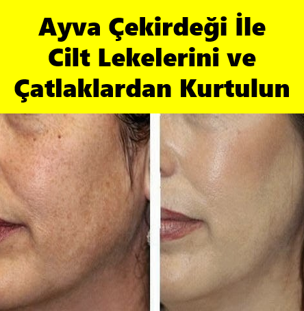 Ayva Çekirdeği İle Cilt Lekeleri ve Çatlaklardan Kurtulabilirsiniz