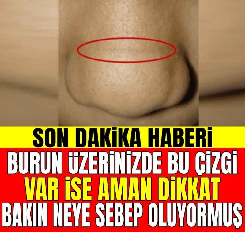 Burnunuzun Üzerinde Bu Çizgiler Varsa...