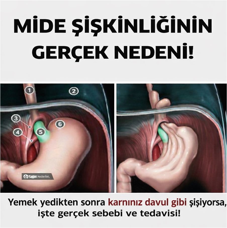 Yemekten Sonra Mide Şişkinliğinizin Sebebi Buymuş