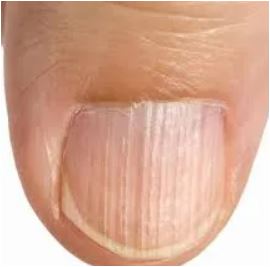 Tırnağınızdaki Dikey Çizgiler