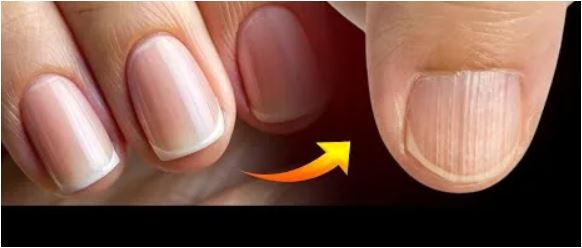 Tırnağınızdaki Dikey Çizgiler