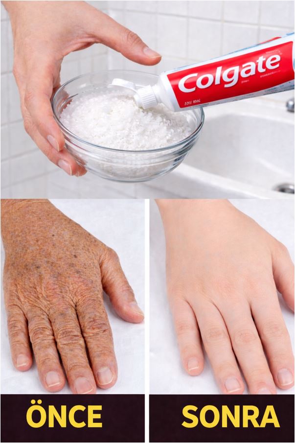 Ellerdeki Lekeleri Ve Kırışıklıklara Silgi Gibi