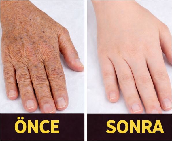 Ellerdeki Lekeleri Ve Kırışıklıklara Silgi Gibi